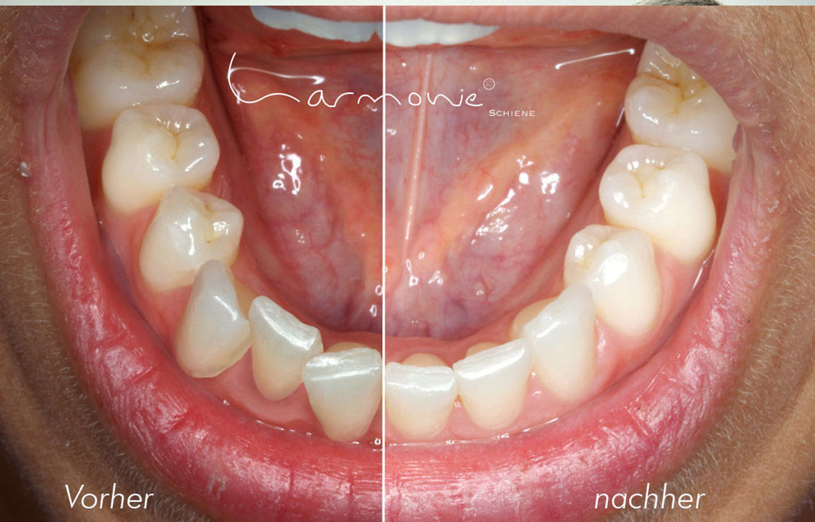 Harmonieschienen − Zahnarzt Bochum