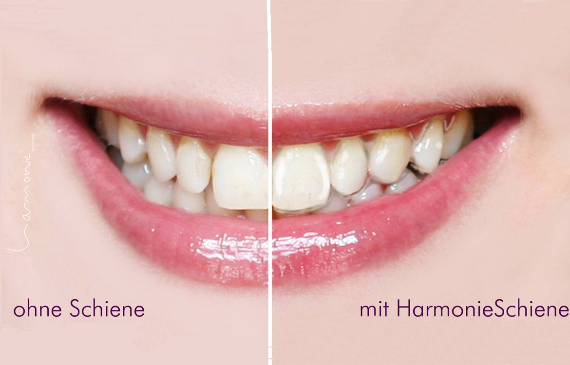 Harmonieschienen − Zahnarzt Bochum